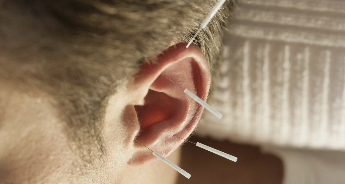 Аурикулотерапия: постановка золотых иголок на уши